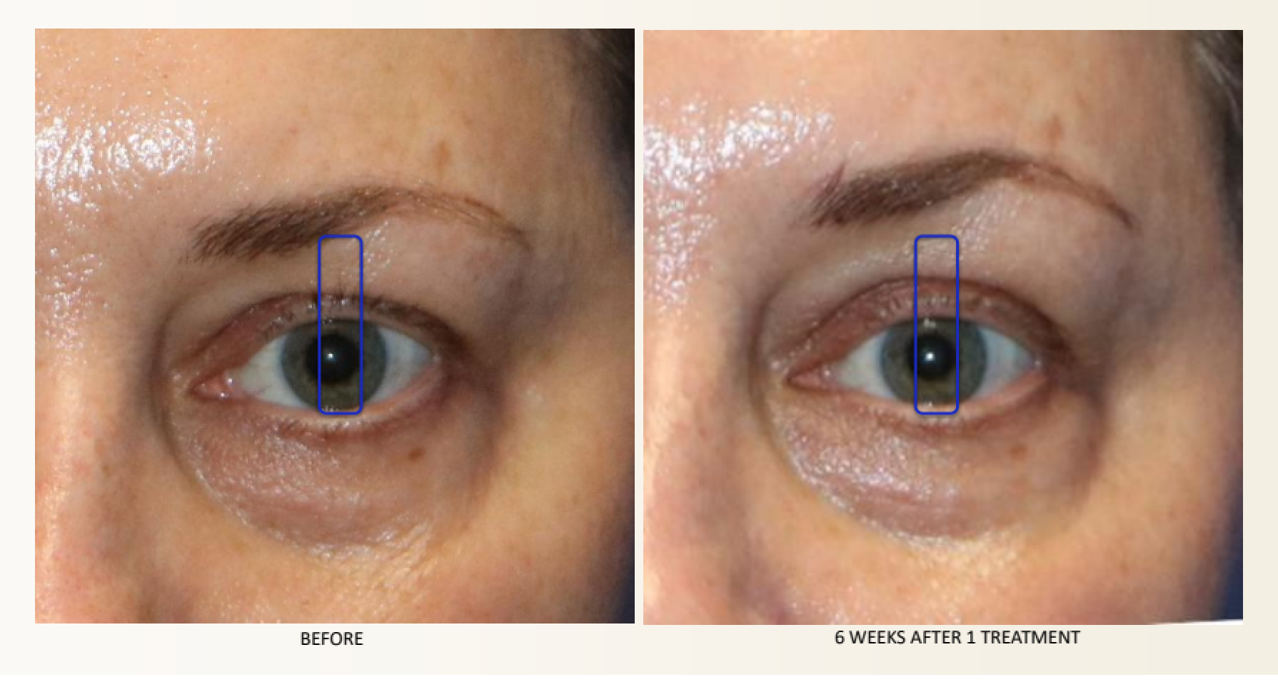 Before-and-after comparison of a woman's eye: dark circles under the eyes are reduced after treatment.