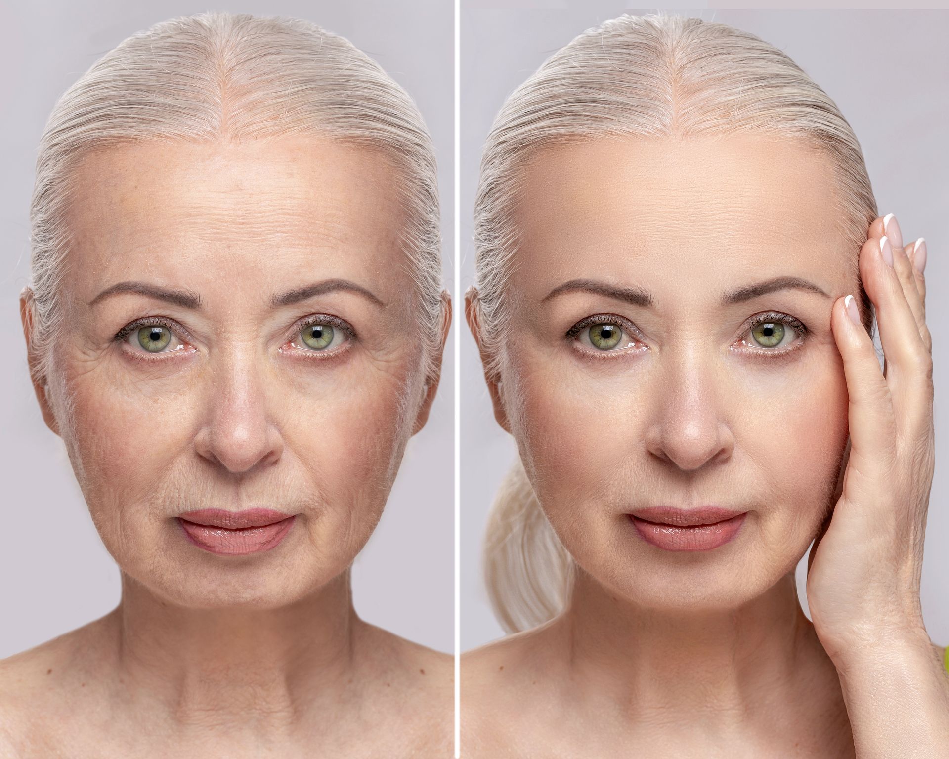 A before and after photo of an older woman 's face.showing laser skin tightening treatment effects