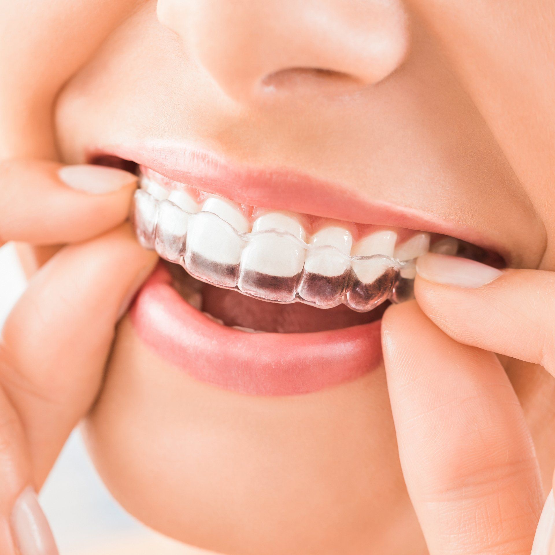 Ancaster invisalign | Invisalign near me