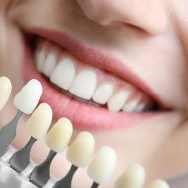 teeth whitening near me | Ancaster teeth whitening