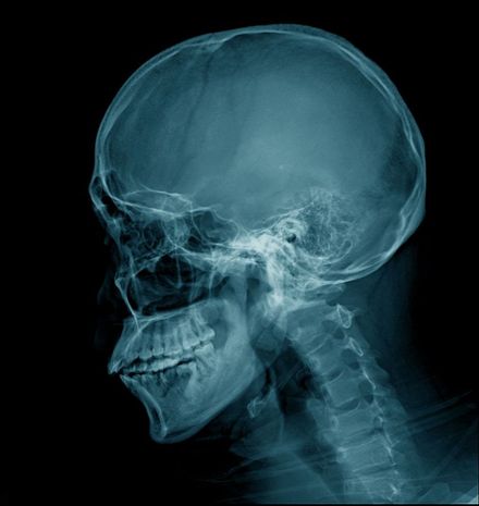 Radiografia lateral do crânio e pescoço humanos em tons de azul.