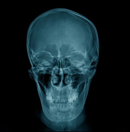 Radiografia de um crânio humano com tonalidade azulada, vista frontal sobre fundo preto.
