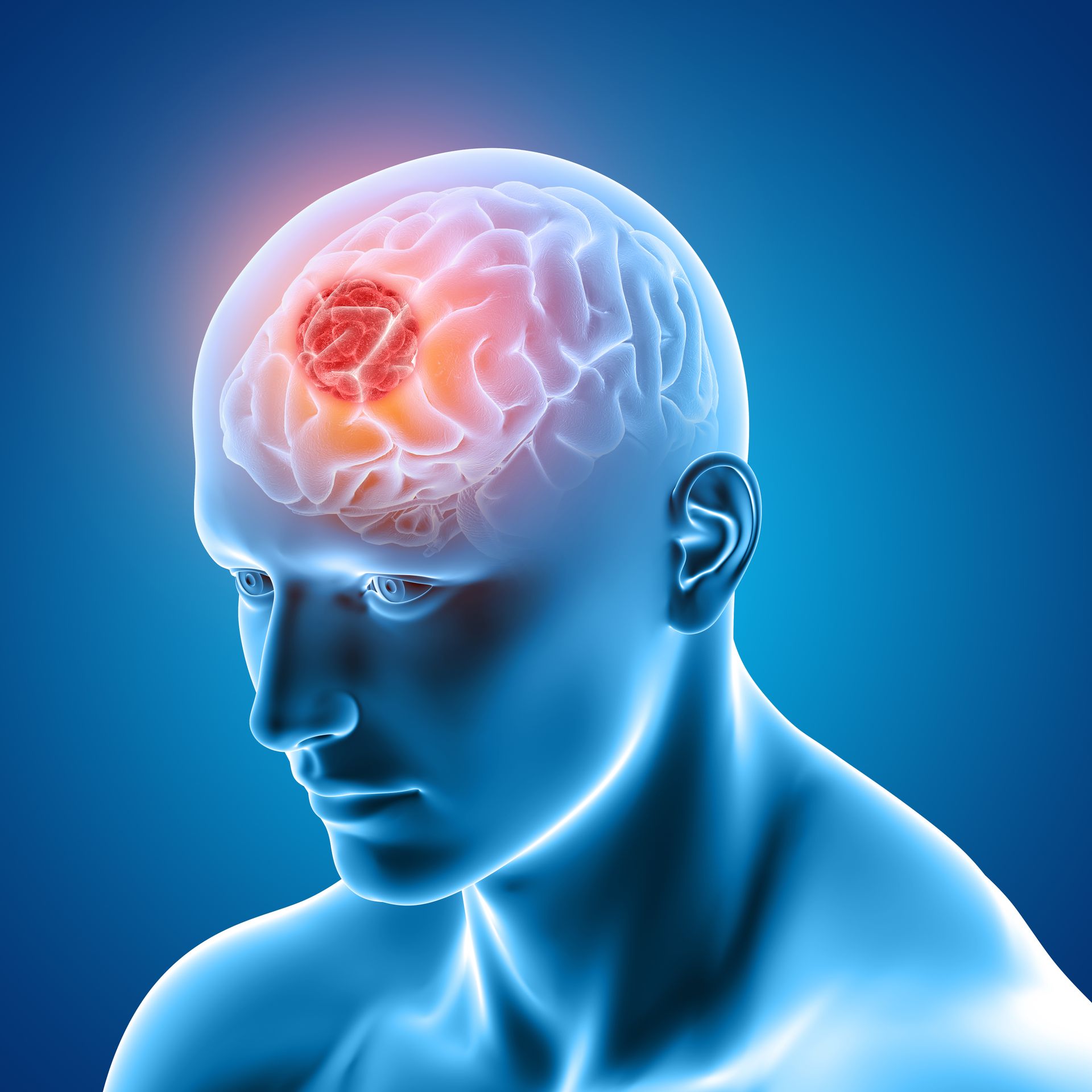 Tumor cerebral tem chance de cura?