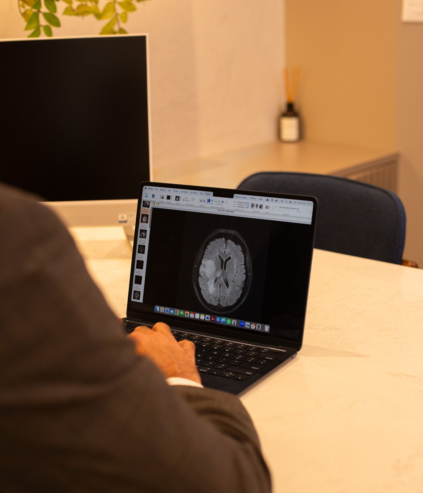 glioblastoma