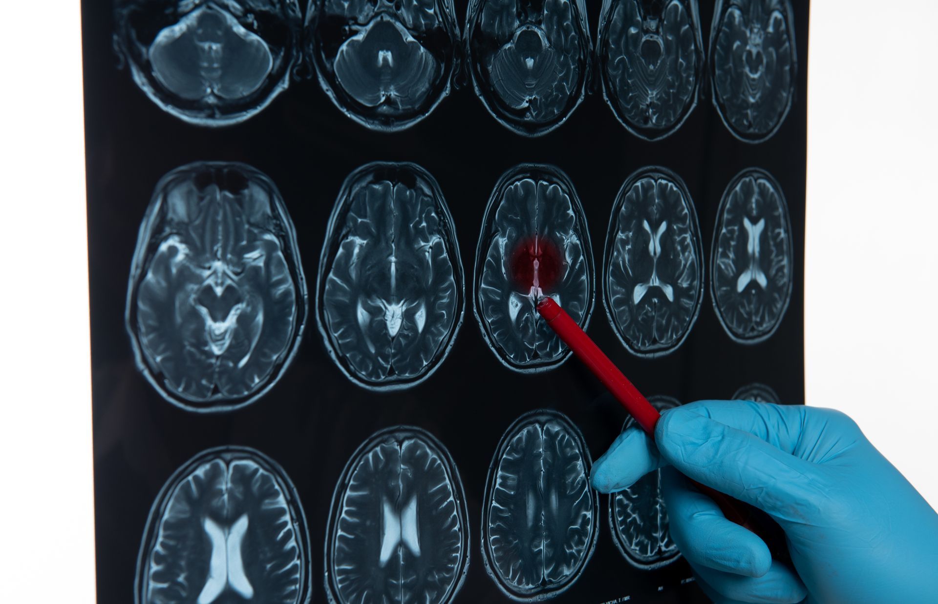 Quais são os sintomas neurológicos de meningioma