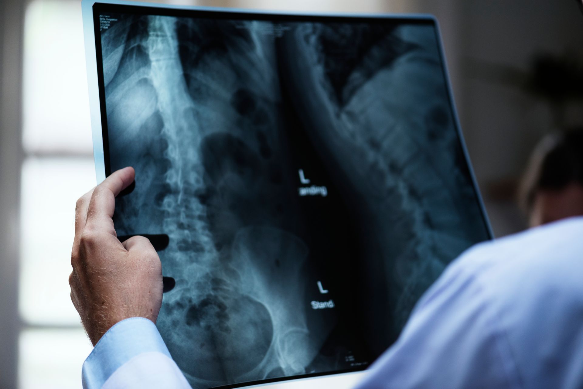 Escoliose: quando a cirurgia é necessária e como é realizada?