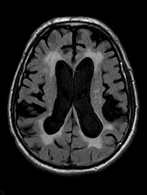 Ressonância magnética axial do cérebro mostrando ventrículos dilatados e alterações na substância branca circundante.