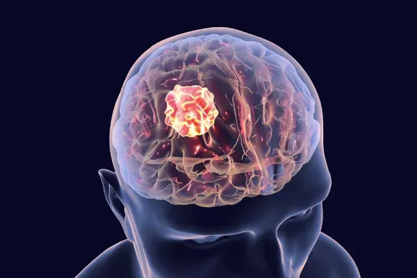 Tomografia cerebral mostrando um cérebro com uma massa avermelhada e brilhante, indicando um tumor.