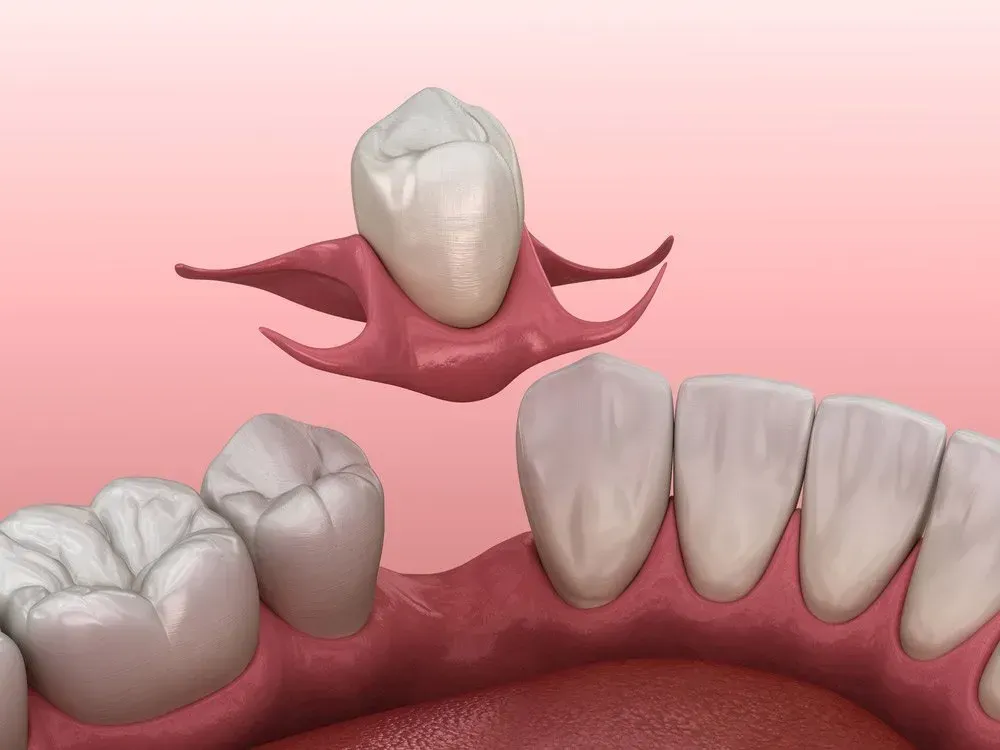 A Computer Generated Image of a Dental Prosthesis in a Mouth — Twin Towns Denture Clinic In Tuncurry, NSW