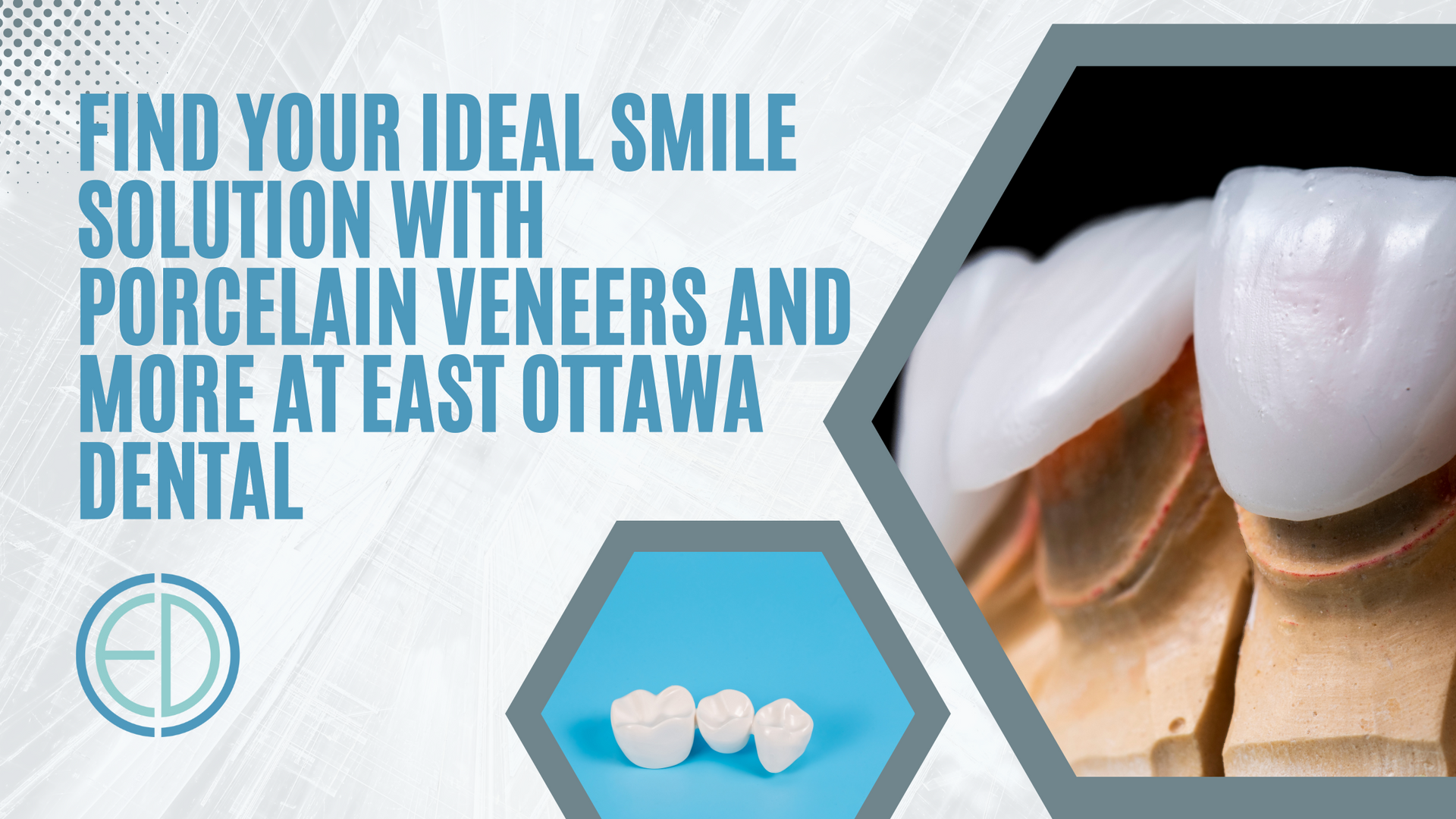 An advertisement for porcelain veneers and more at east ottawa dental