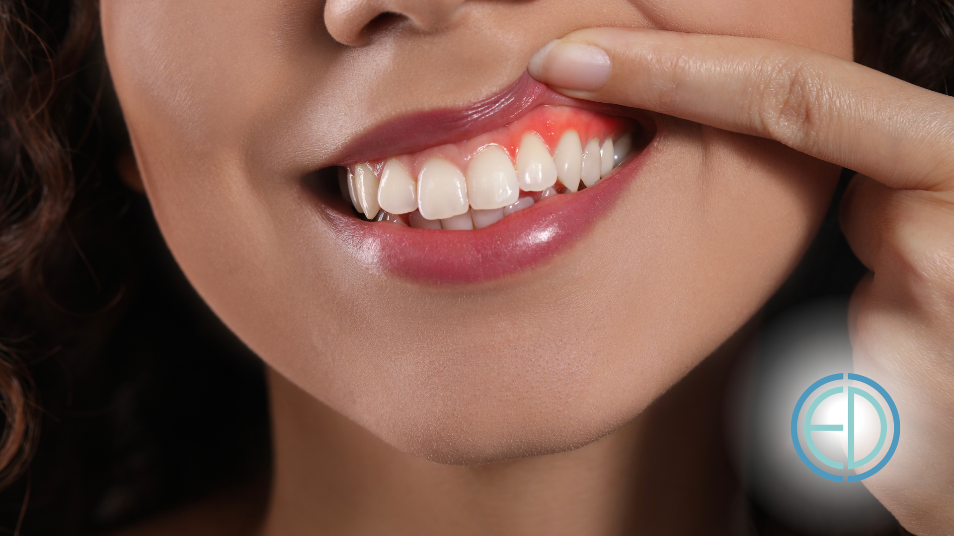 Close-up of a smiling mouth with a finger pointing at a chipped front tooth