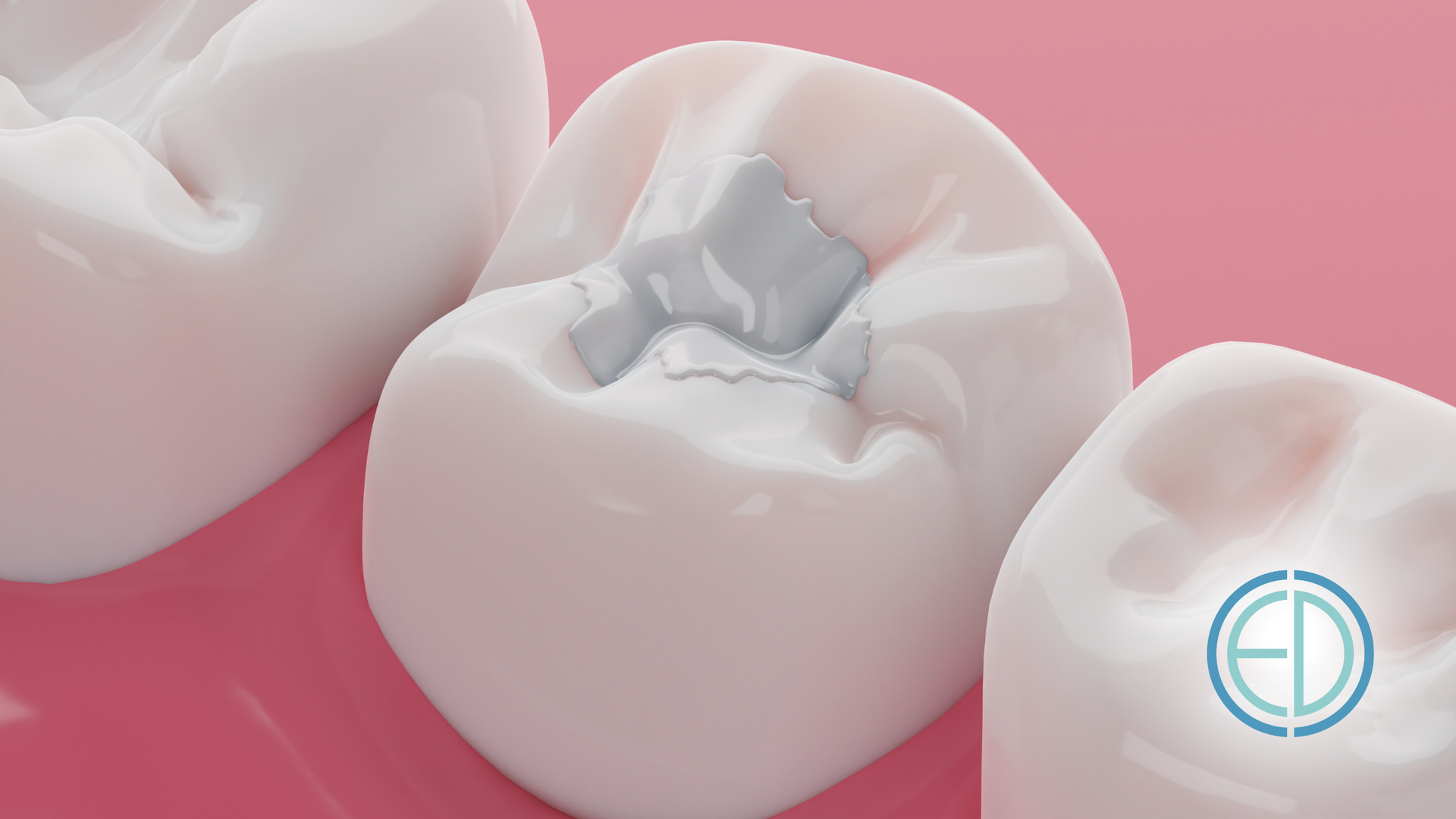 A close up of a tooth with a filling in it on a pink surface.