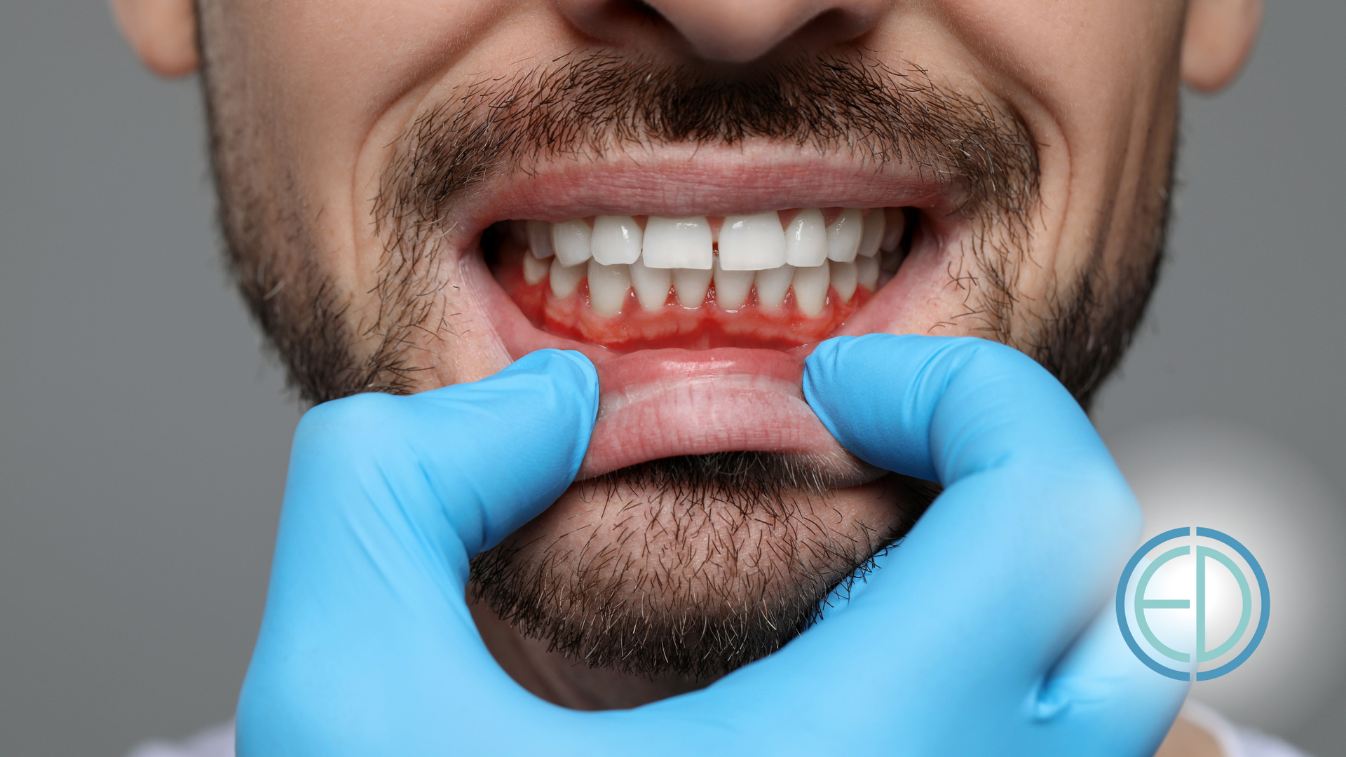A man with a beard is getting his teeth examined by a dentist.