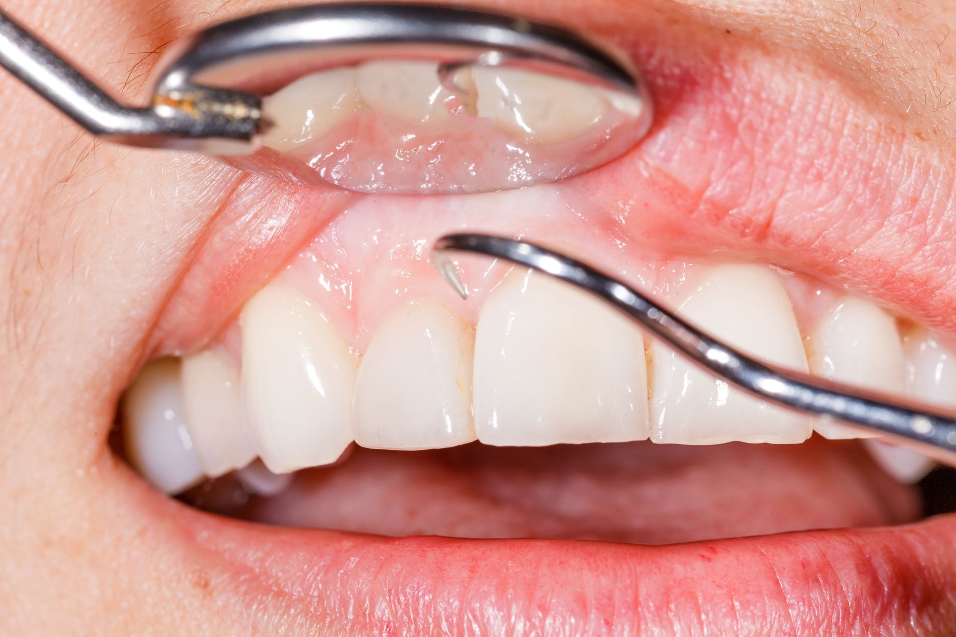 Dental examination showing gum recession and probing around teeth to assess gum disease 