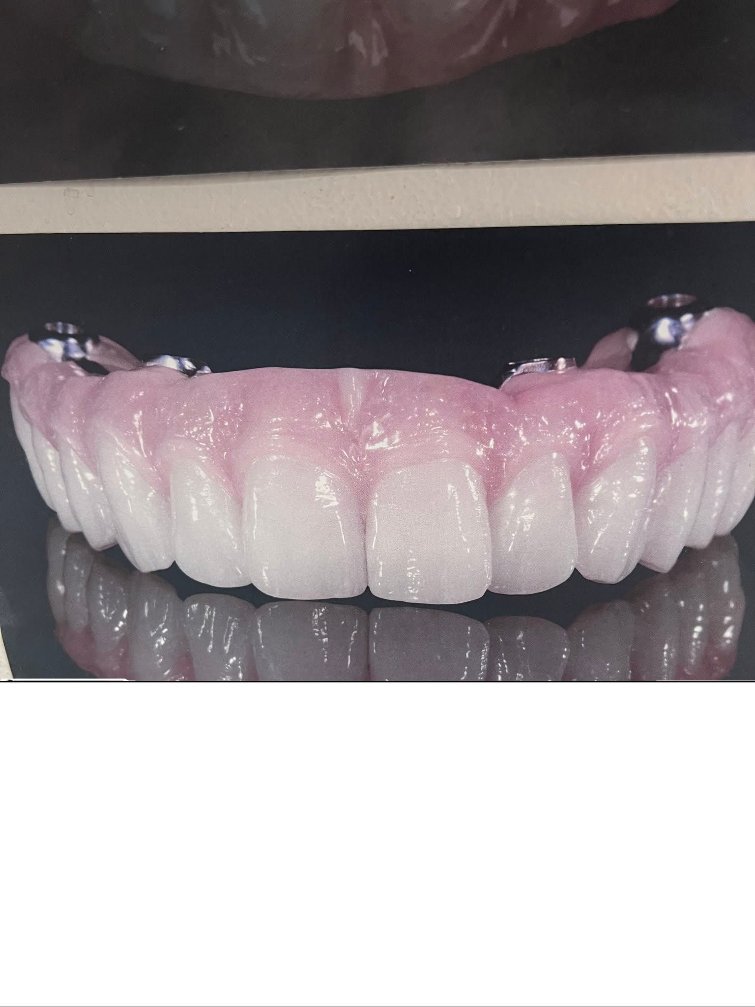 Full set of dentures on reflective surface – custom dentures by Superb Dental Lab