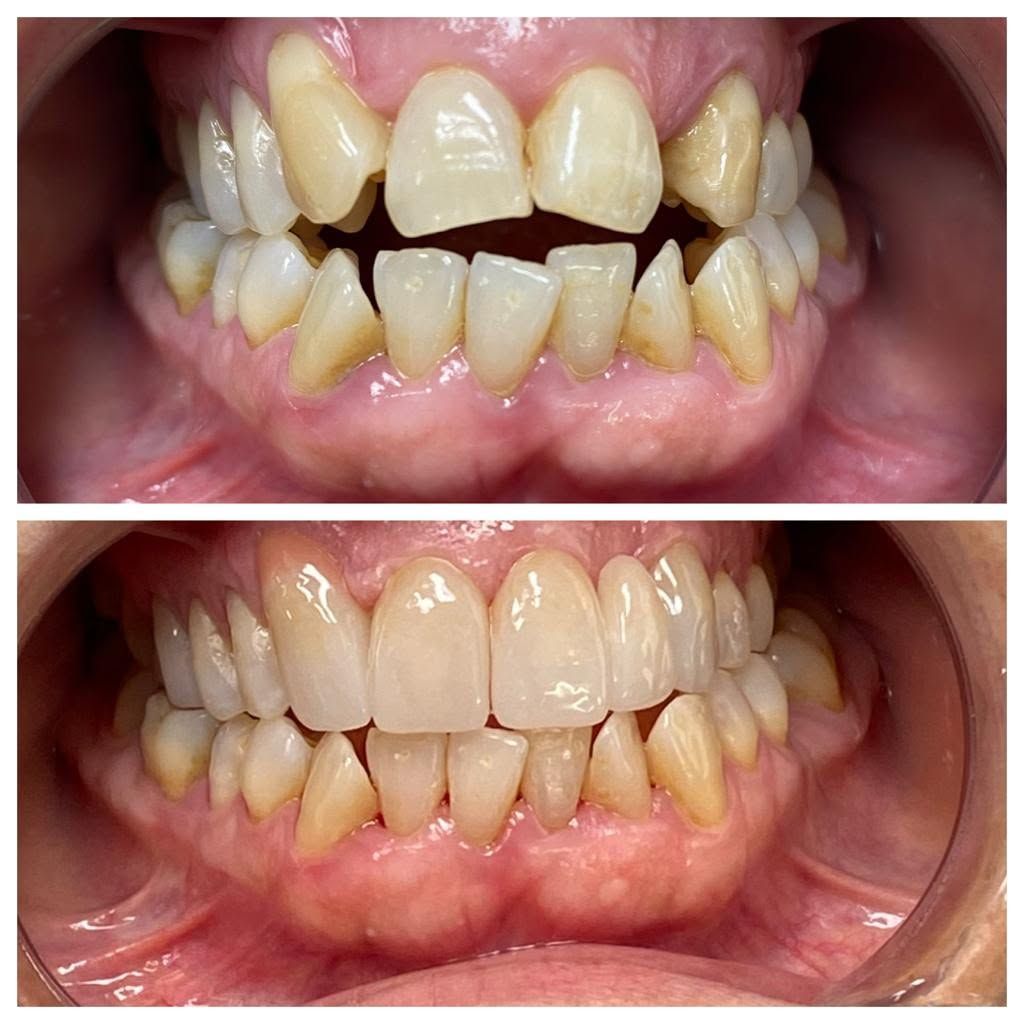 Before and after dental treatment showing improved tooth alignment and whitening – Superb Dental Lab