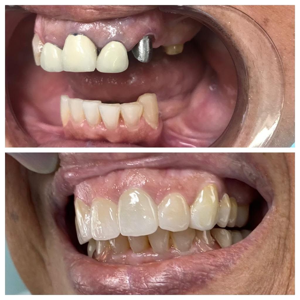 Before and after photos showing missing front tooth and dental posts – dental restoration case