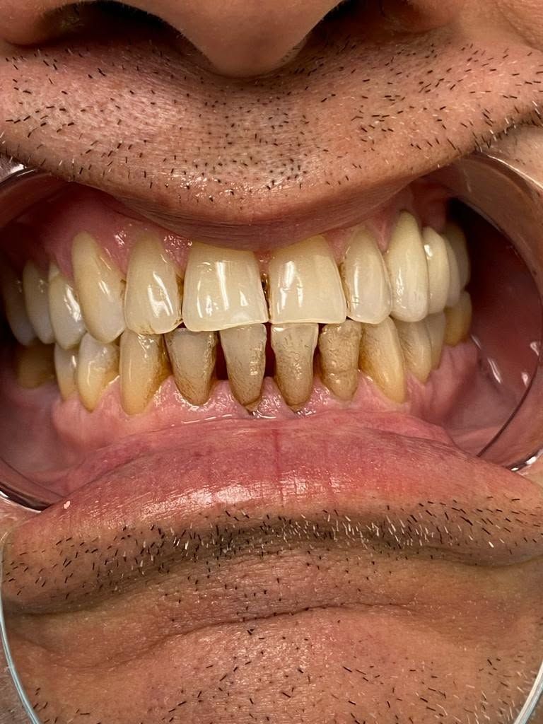 Close-up of lower teeth showing staining – dental case example