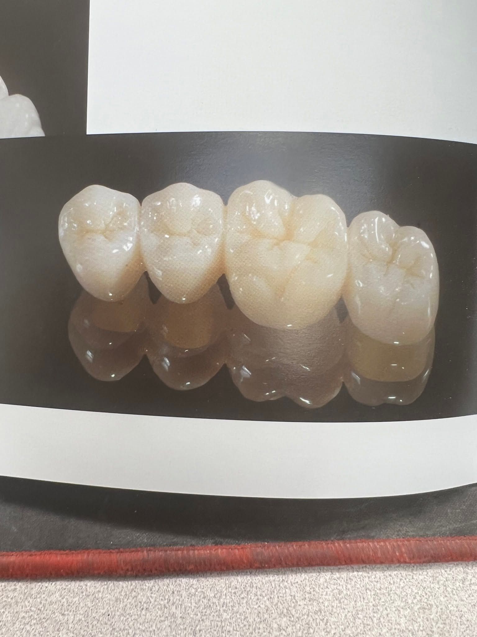 Four dental crowns on display – Superb Dental Lab Lynbrook NY