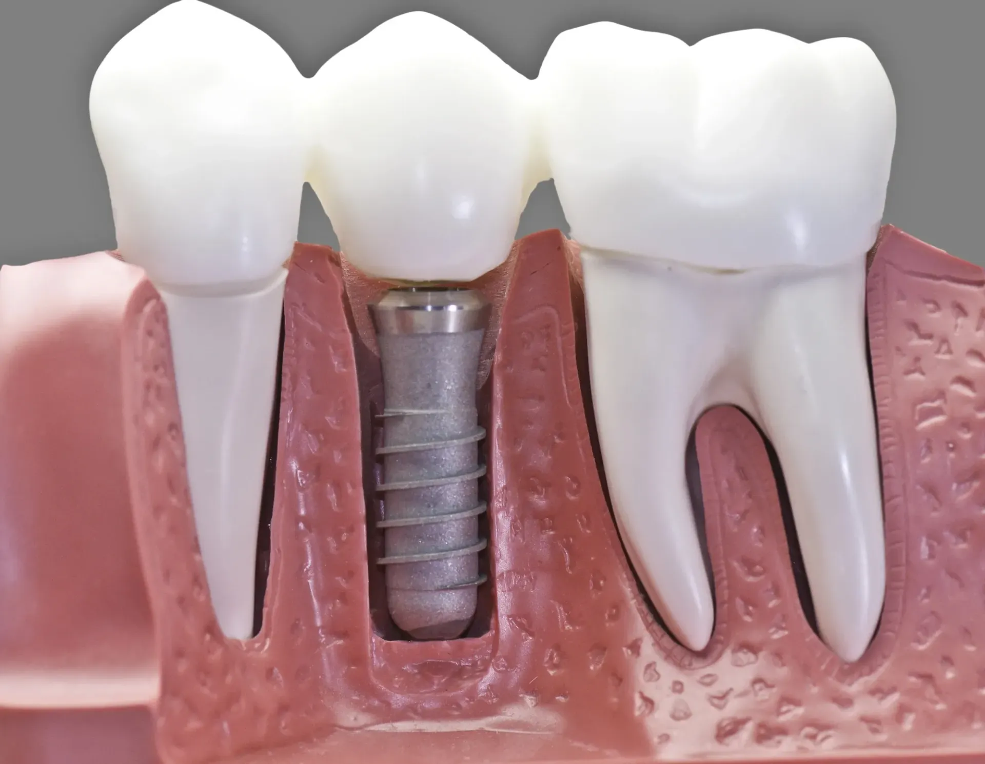 dental+implants+in+Missoula-+MT