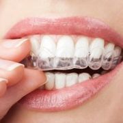 Un gros plan de la bouche d'une femme avec un appareil dentaire sur les dents.