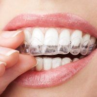 Un gros plan de la bouche d'une femme avec un appareil dentaire sur les dents.