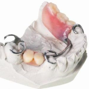 A model of a mouth with a denture on it