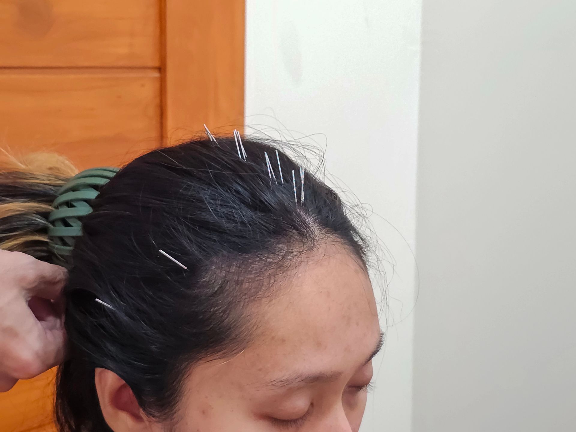 Scalp Acupuncture in North Hollywood, CA
