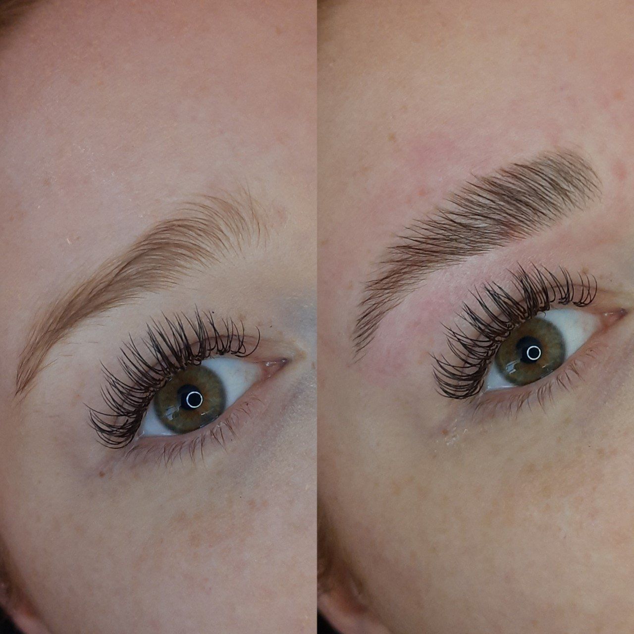 brow lift amsterdam