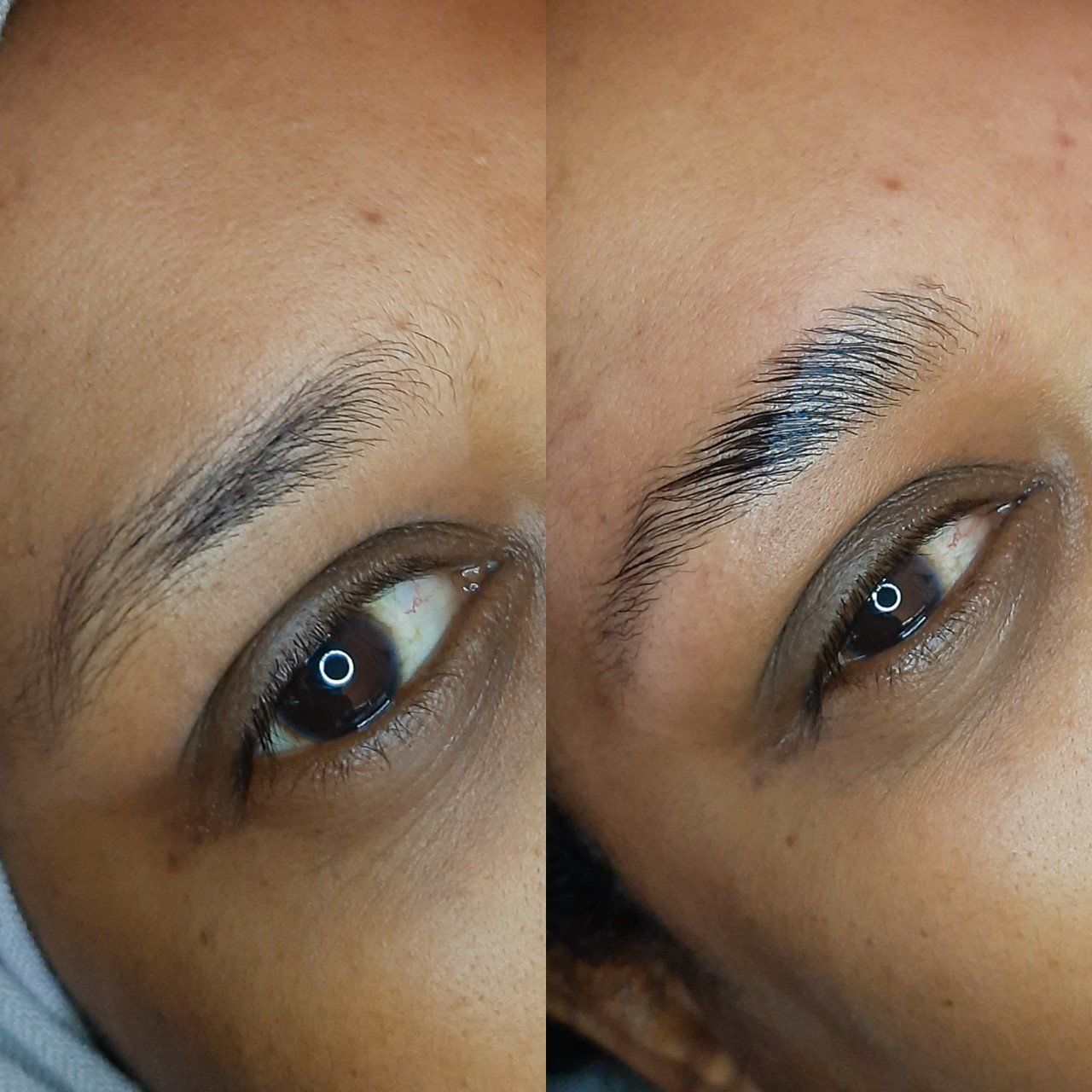brow lift heemstede