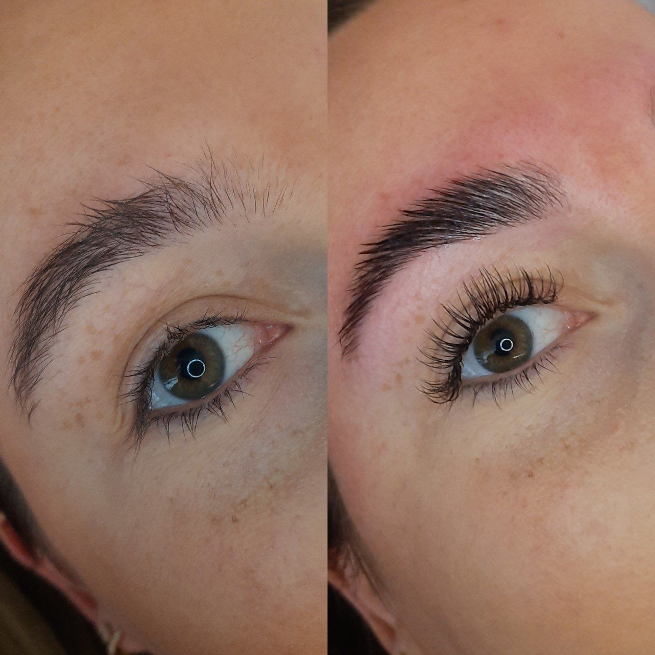Brow lifts haarlem