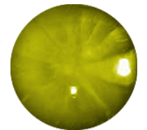 Cortical Cataracts