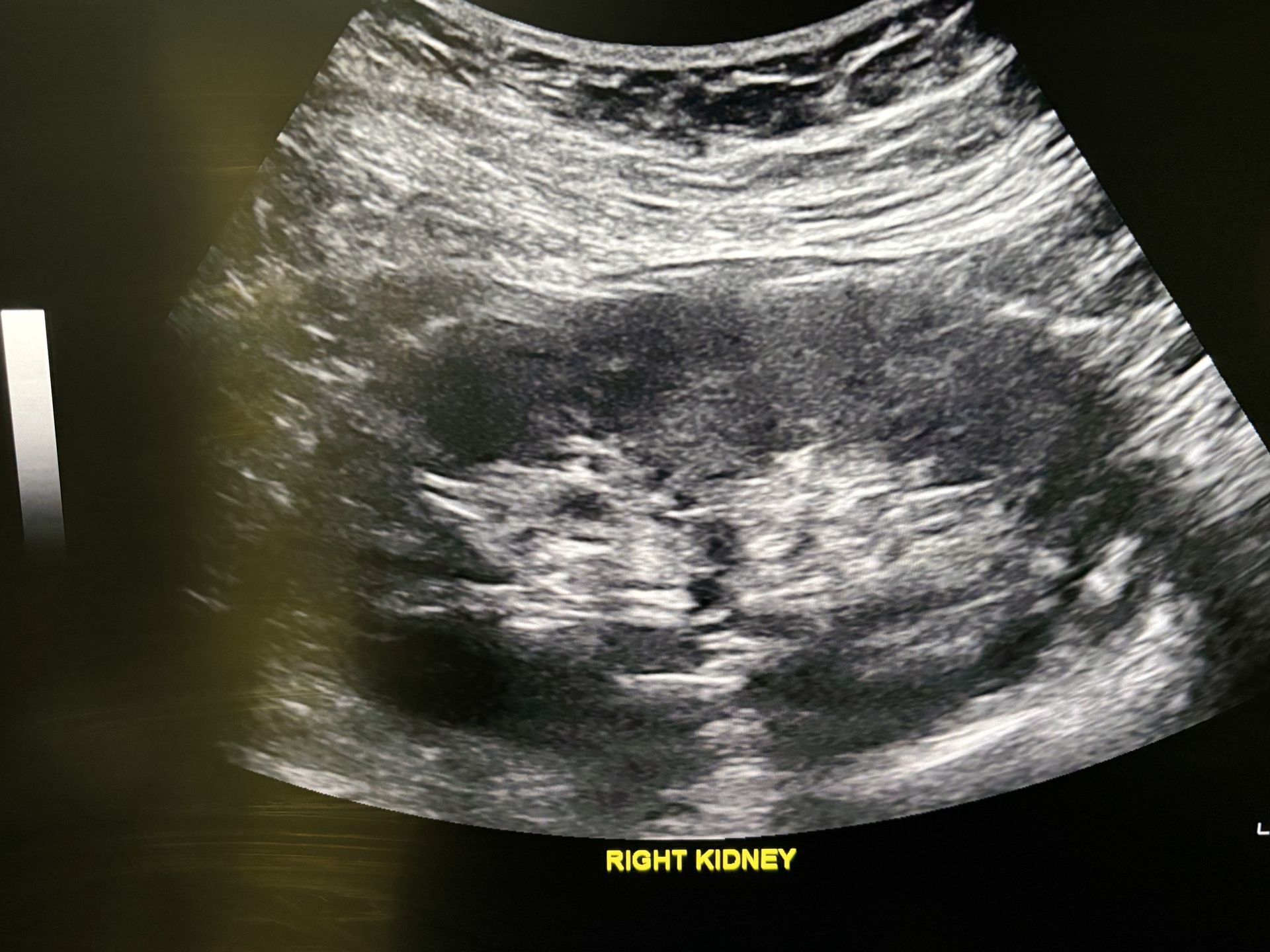 A computer screen shows an ultrasound of a kidney