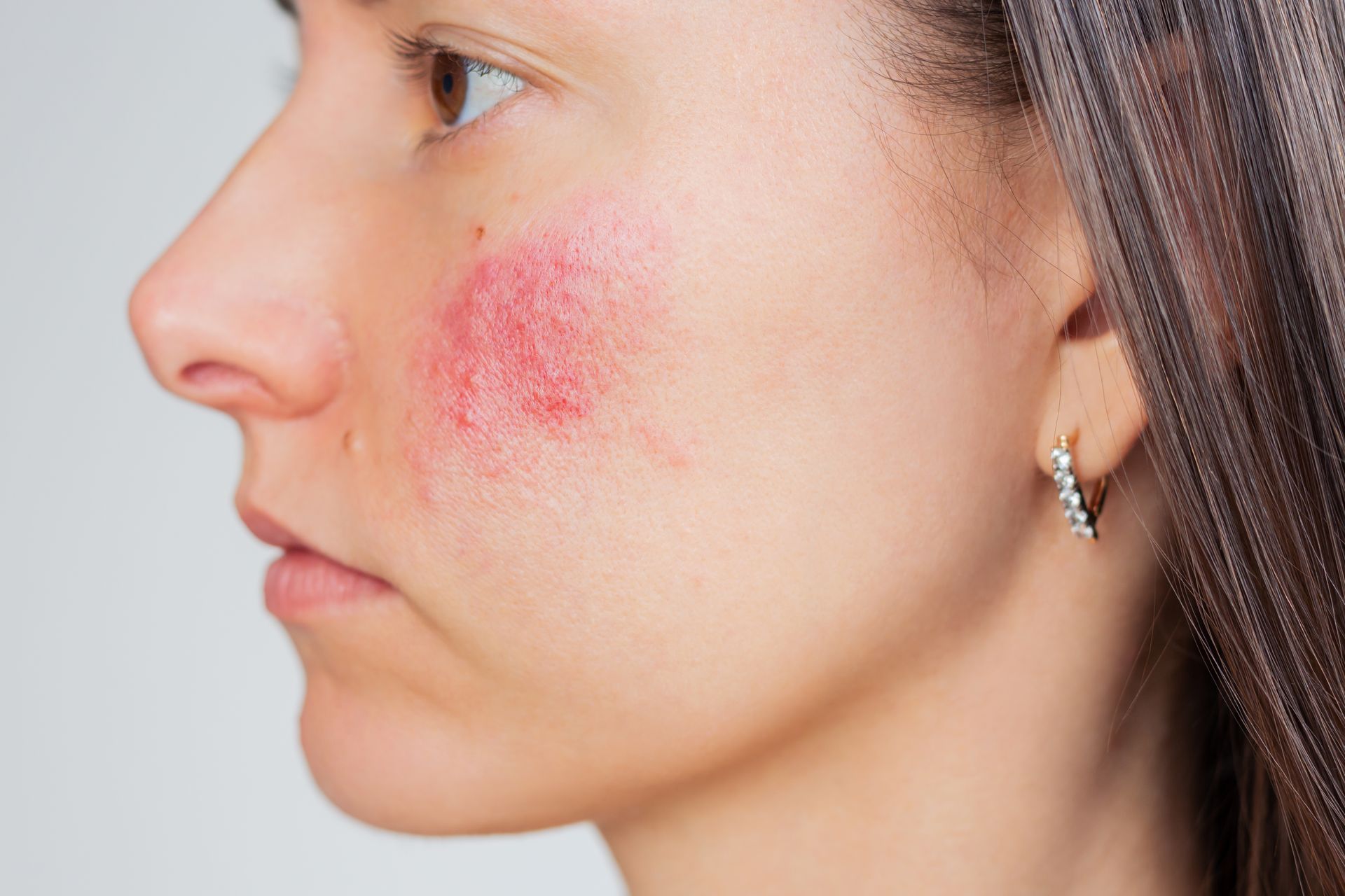 Close-up profile of a person with a red rash on the cheek and visible earring