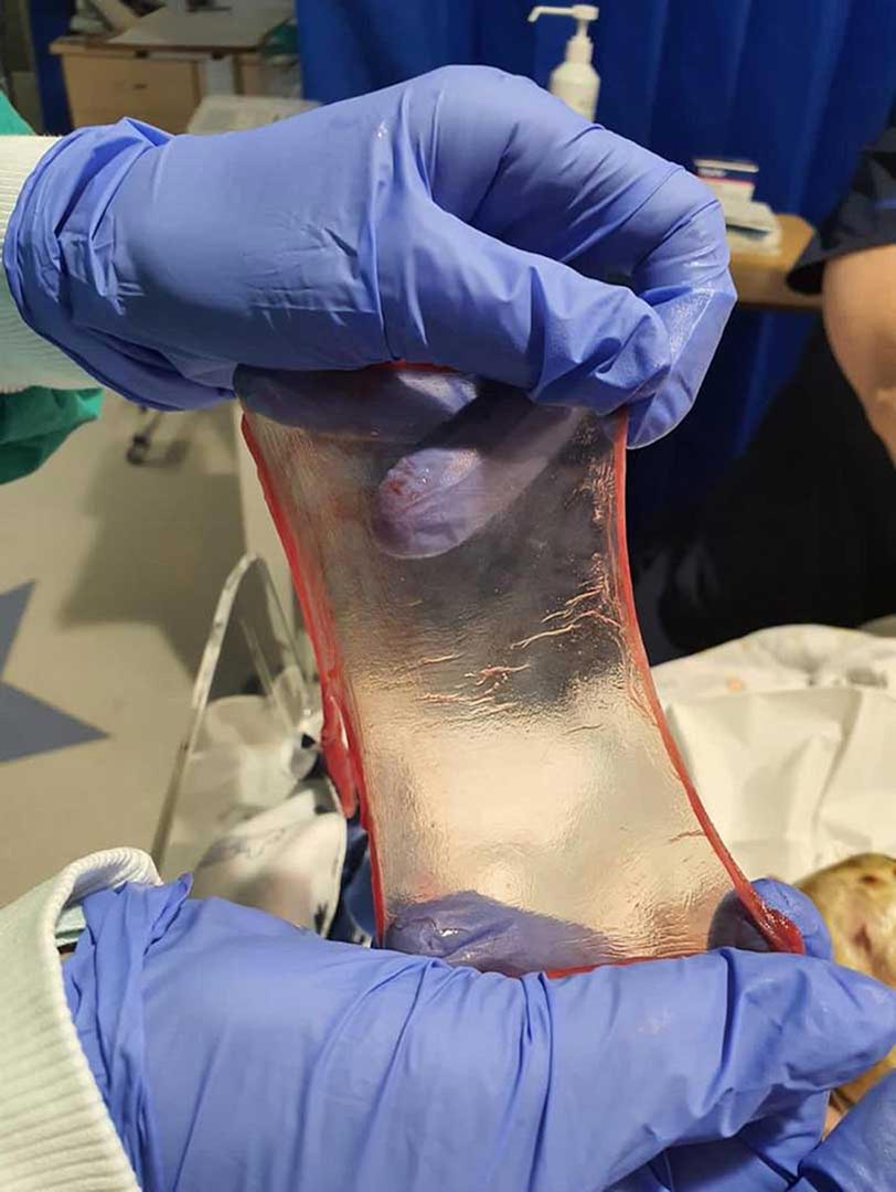 Born with exomphalos