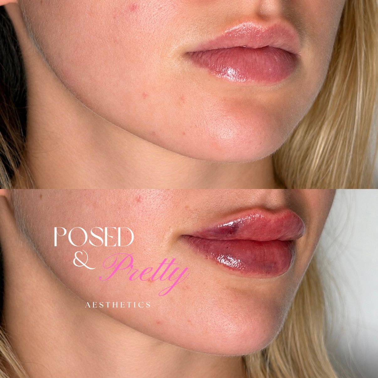 Before Lip Filler 3