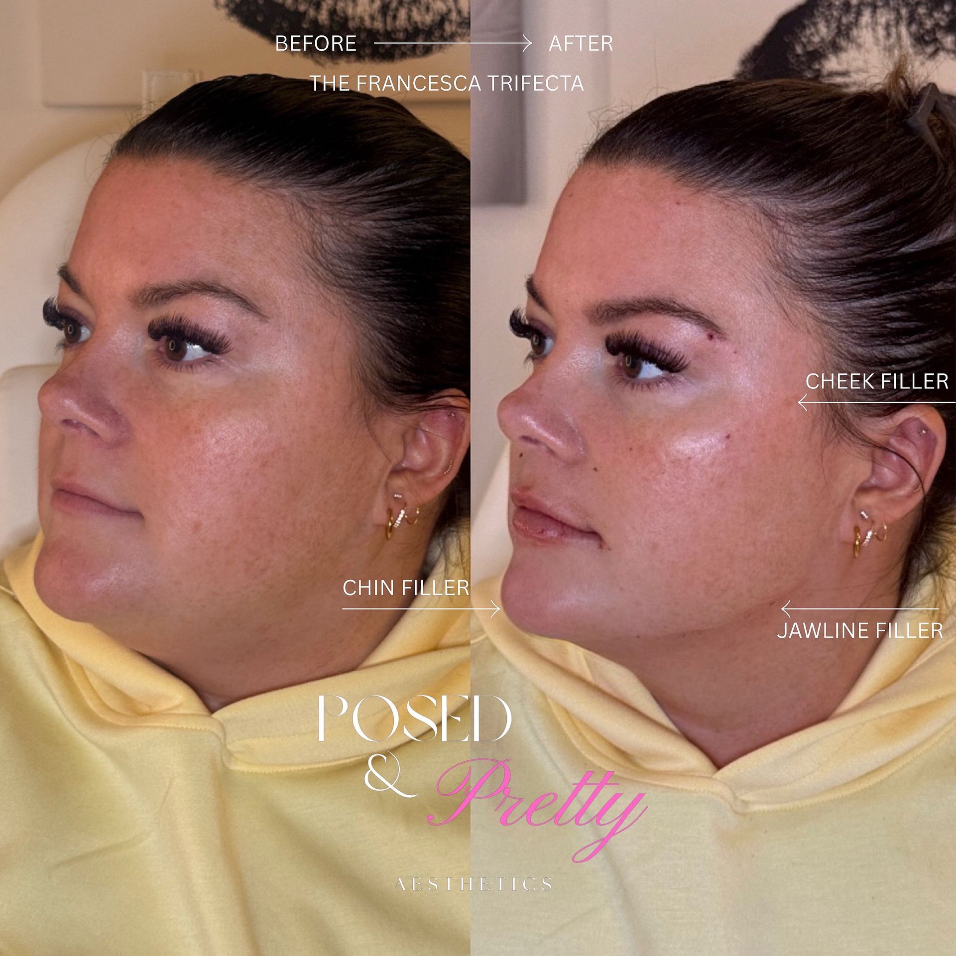 Before Cheek Contour 2