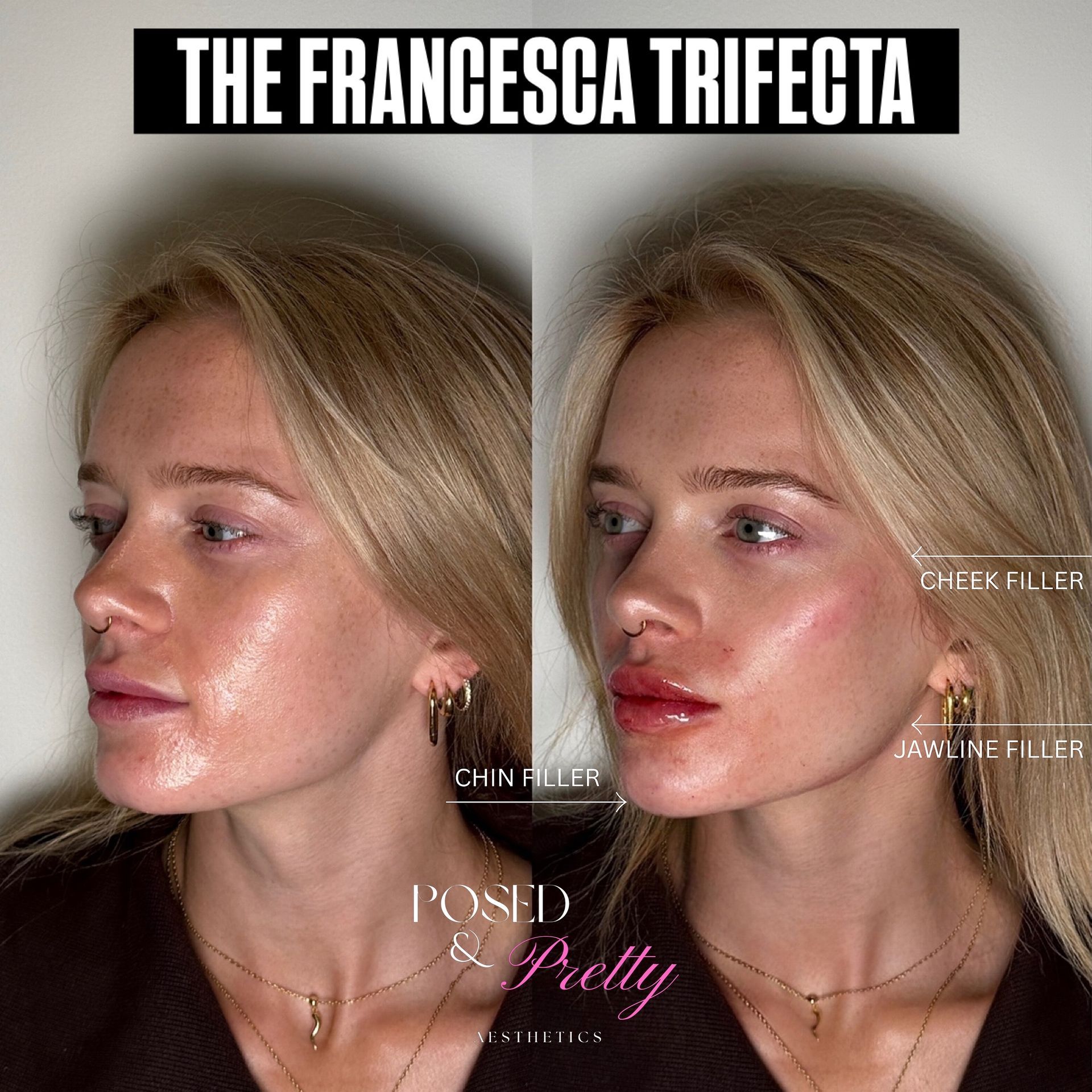 After Cheek Contour 2