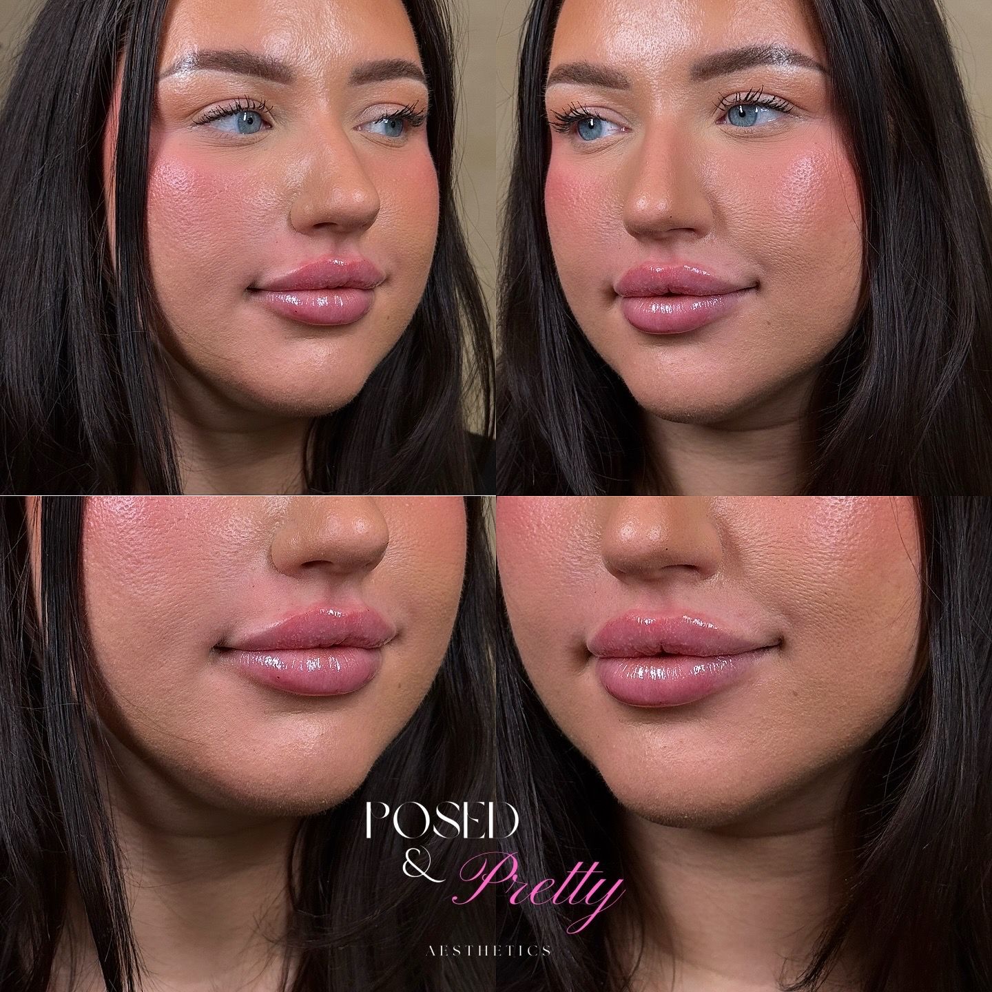 Before Lip Filler
