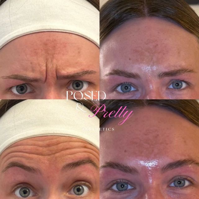 Skin Rejuvenation treatment
