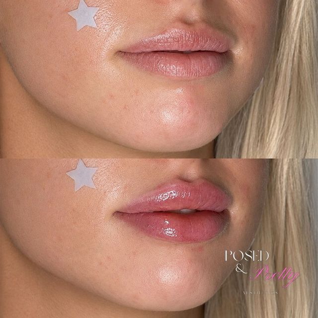 Lip Design treatment