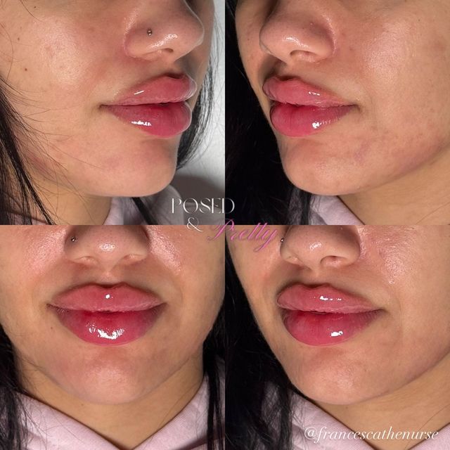 Doll lips result