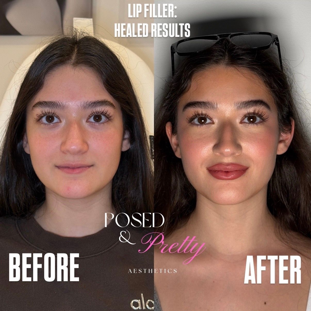 Before Cheek Contour