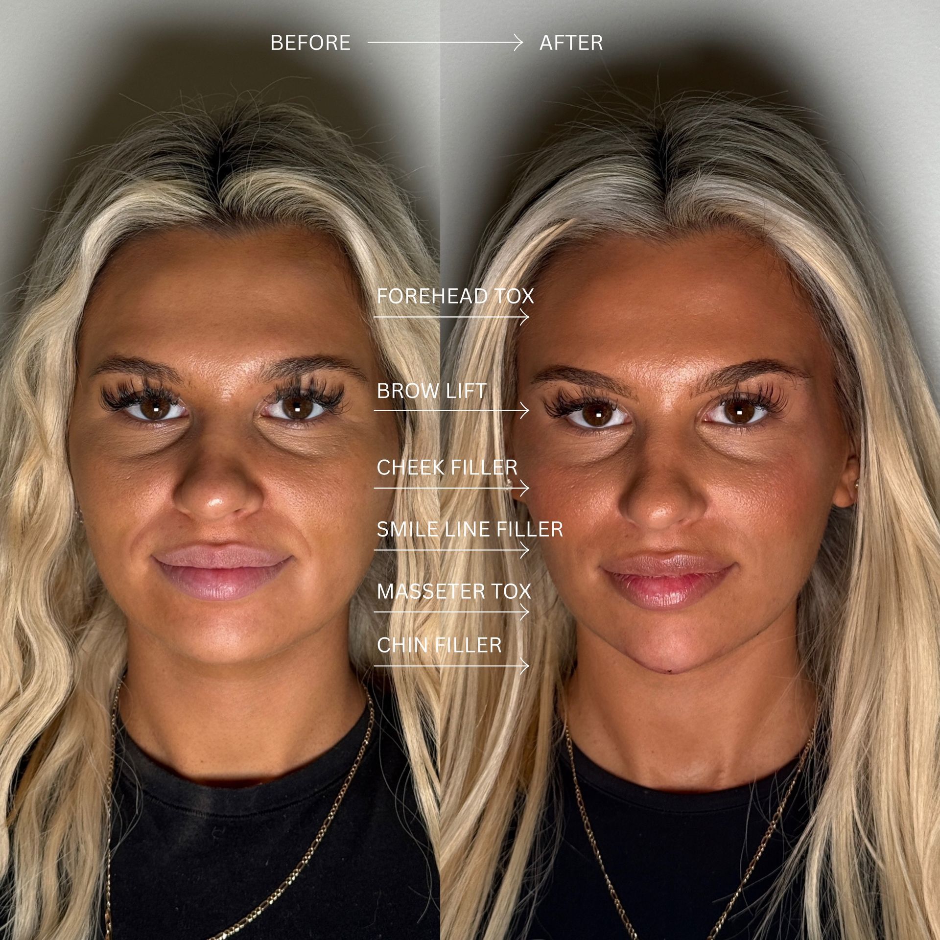 After Cheek Contour