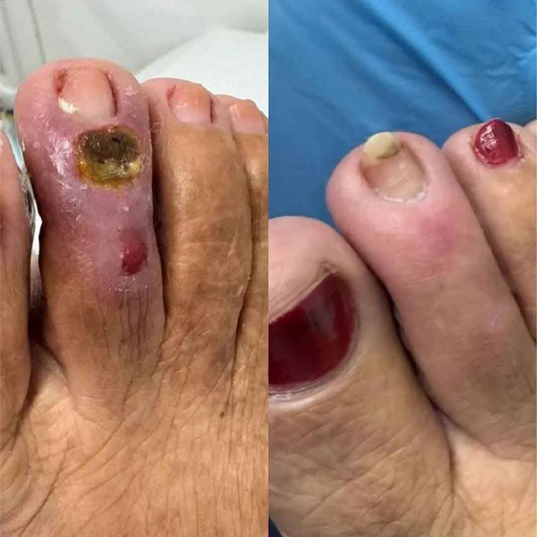 Imagem em close-up de dedos inchados com feridas escuras e crostas, além de áreas vermelhas e irritadas nas unhas de um pé.