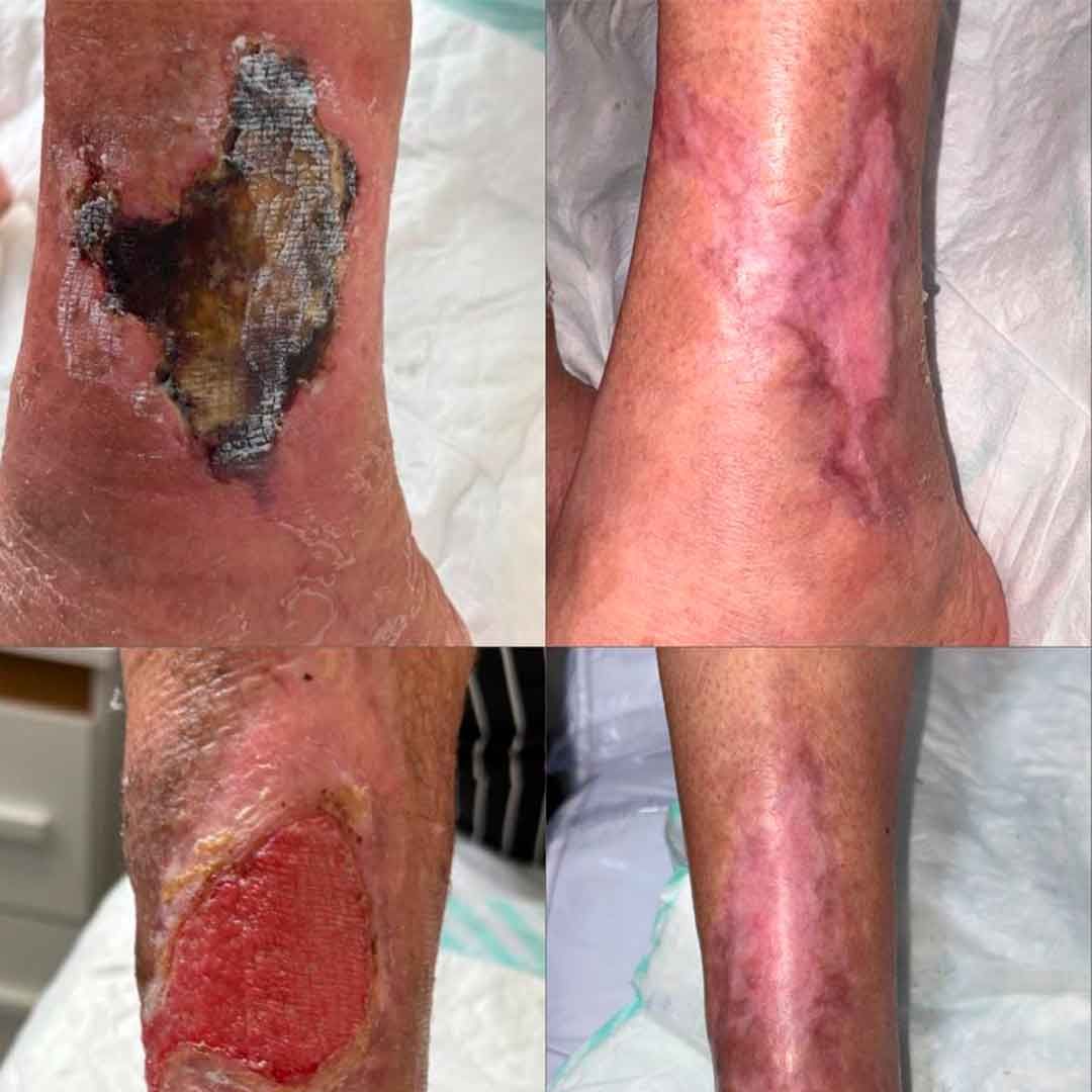 Perna em diferentes estágios de cicatrização.
