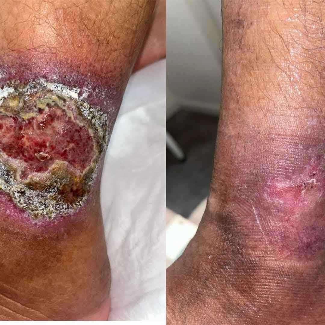 Imagem aproximada de uma perna com uma grande ferida aberta e uma cicatriz em processo de cicatrização no tornozelo.