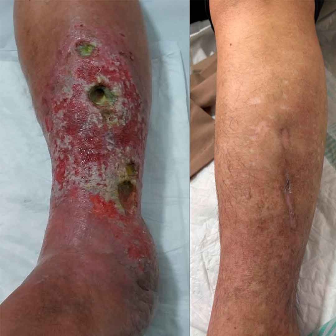 Duas imagens de uma perna inchada com feridas vermelhas e ulceradas e crostas.
