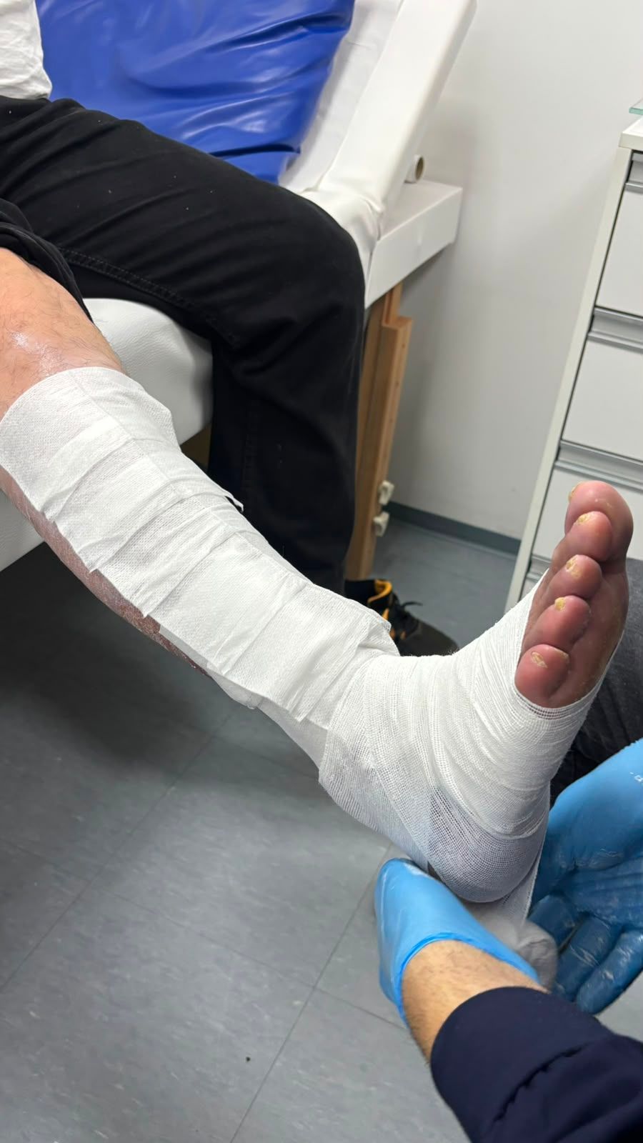 Perna enfaixada com gesso branco durante atendimento médico, com os dedos expostos e uma mão enluvada apoiando o pé.