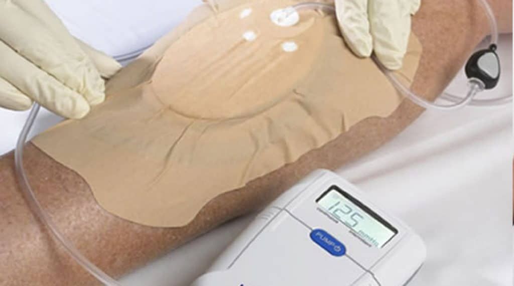 Demonstração de uso de aparelho de terapia por pressão negativa em um paciente de feridas